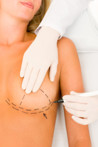 Breast Implant Revision Surgery | Dr. Bradley Hubbard | Dallas TX